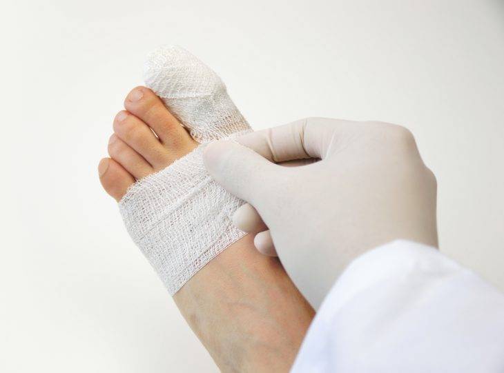 Сколько носить гипс при переломе пальца на ноге | irksportmol.ru