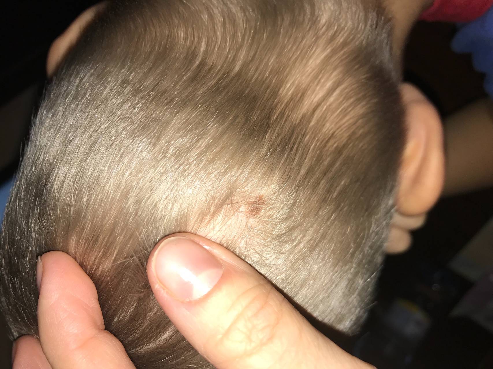 Формы проявления и методы лечения лишая у ребенка на голове в волосах