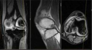 Как проходит мрт связок коленного сустава: подготовка, сколько времени делается томография