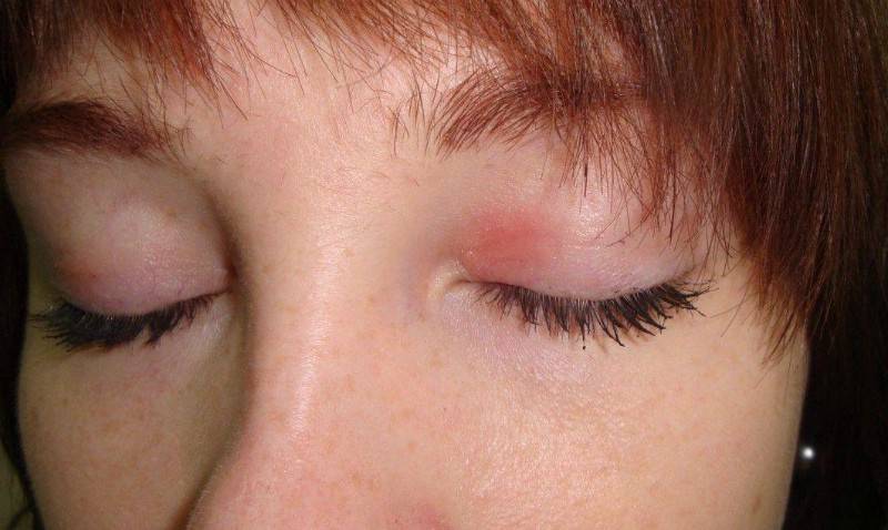 Лечение аллергии на глазах - глаза чешутся, краснеют и отекают