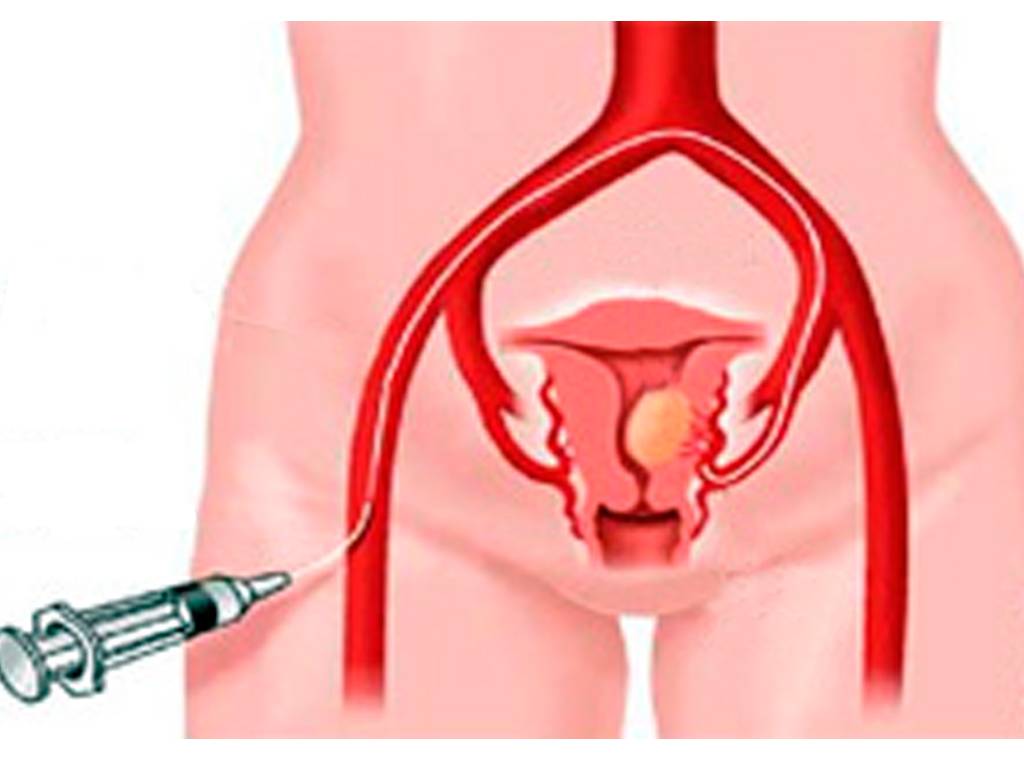 Применение эмболизации маточных артерий при миоме матки