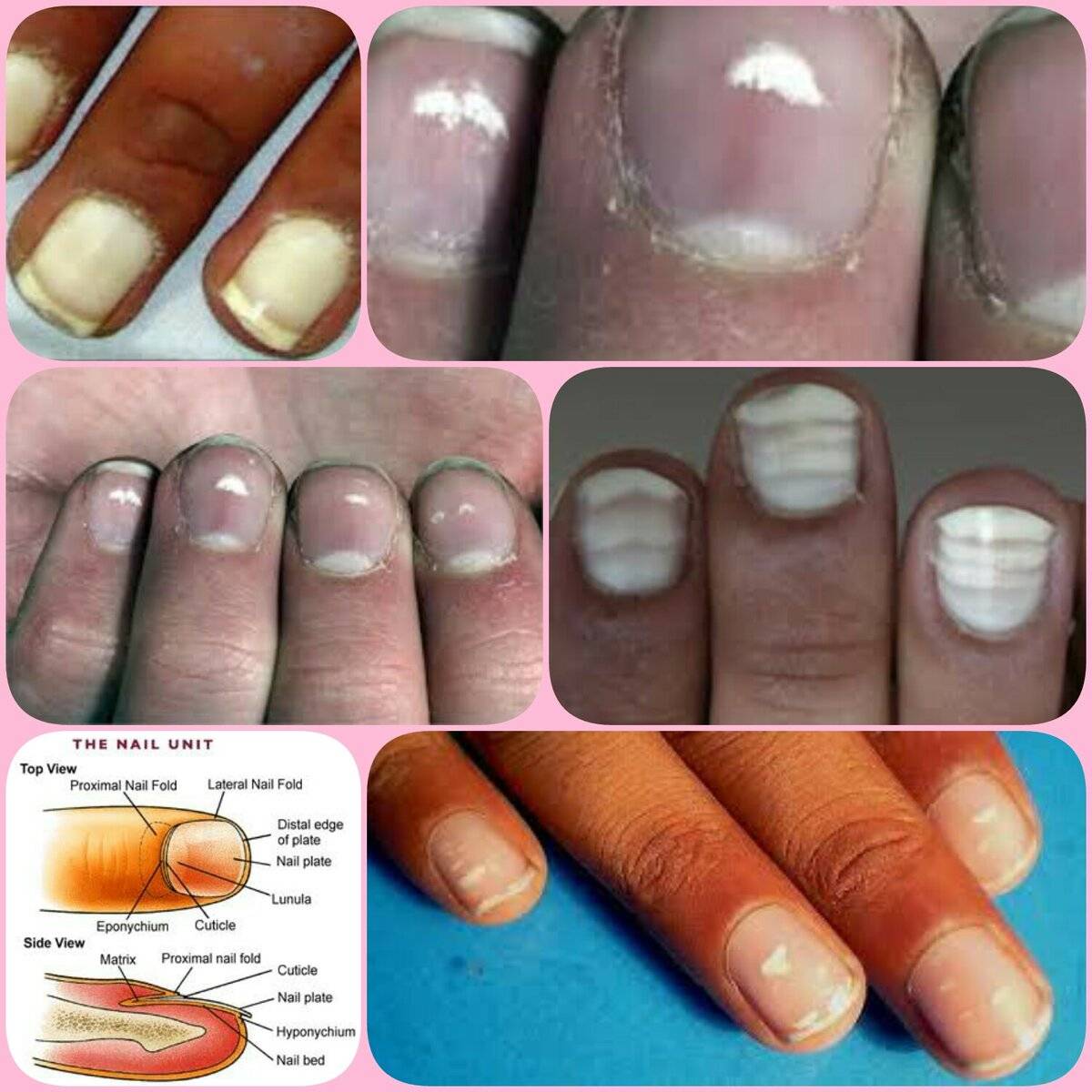 Причины белых пятен на ногтях пальцев рук у взрослых и детей, лечение точек