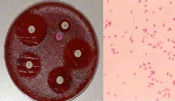 Бактерия моракселла: диагностика и лечение