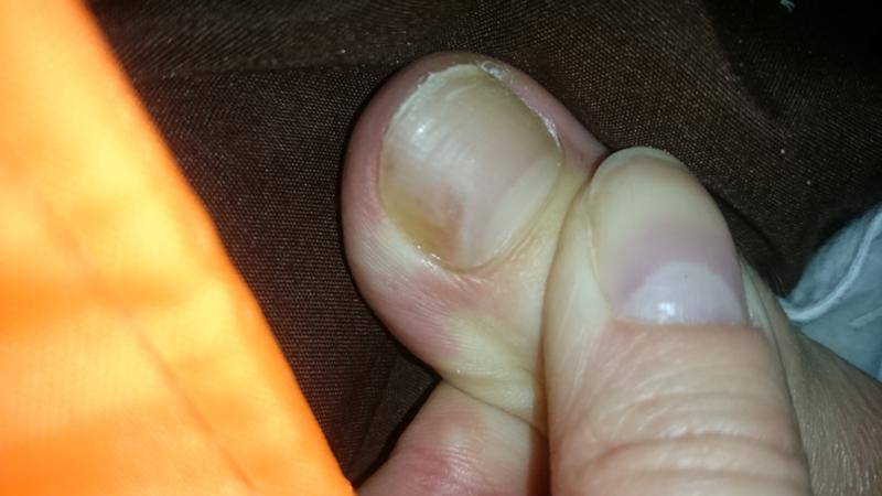 Почему желтеют ногти на ногах и руках у женщин, мужчин, детей: причины. как лечить желтые ногти на руках и ногах?