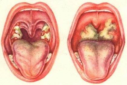 Стафилококк горла симптомы у взрослых лечение | целебные свойства растений