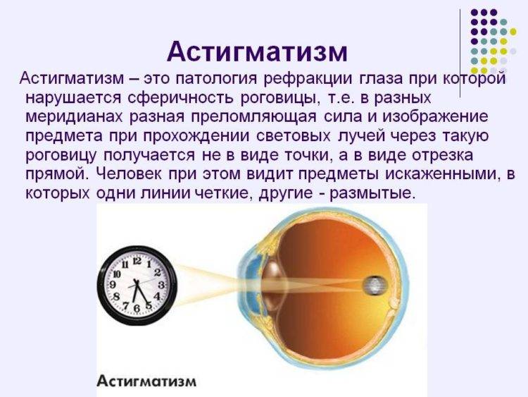 Миопический астигматизм глаз: причины, симптомы, виды и степени заболевания