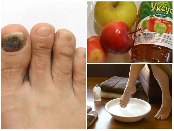 Самые сильные средства для лечения запущенной формы грибка ногтя на ногах и руках в домашних условиях