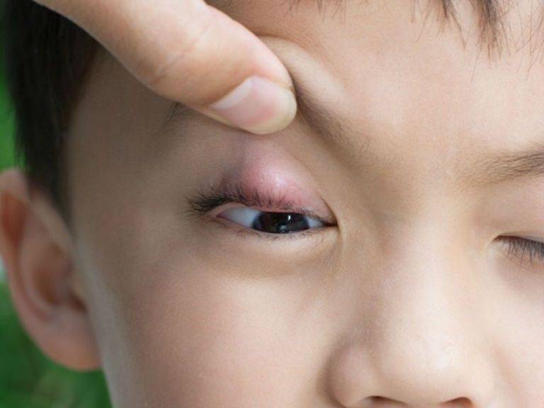 Ячмень на глазу у ребёнка: причины и лечение - "здоровое око"
