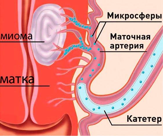 Лечение миомы матки: удаление или эмболизация маточных артерий?