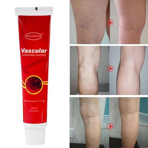 Лечение варикоза вен на ногах: эффективные народные средства