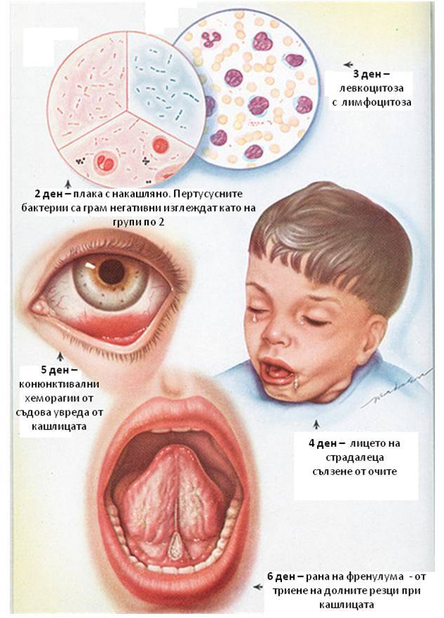 Коклюш - симптомы у детей и взрослых, причины, лечение