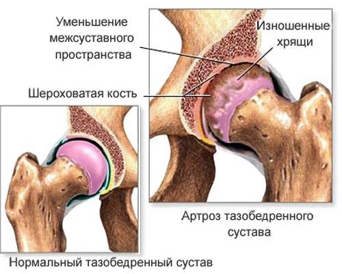 Народные методы для лечения артрита тазобедренного сустава