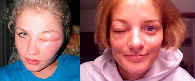 Аллергический отек лица: что делать, как снять, лечение