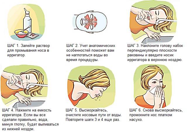 Сколько раз можно промывать. Как быстро вылечить насморк. Как правильно промывать нос солевым раствором. Как промыть нос солевым раствором. Как вылечить сопли за 1 день в домашних условиях.