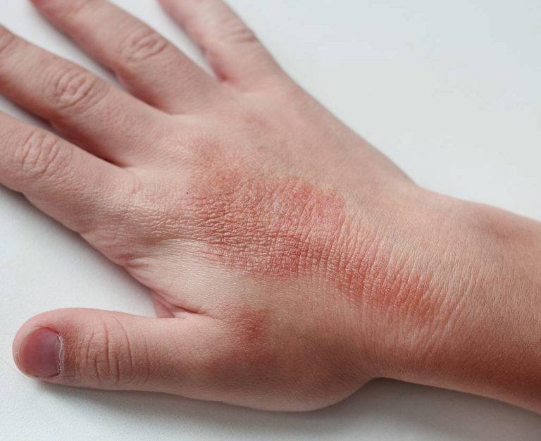 Аллергический дерматит на руках лечение | лечим аллергию