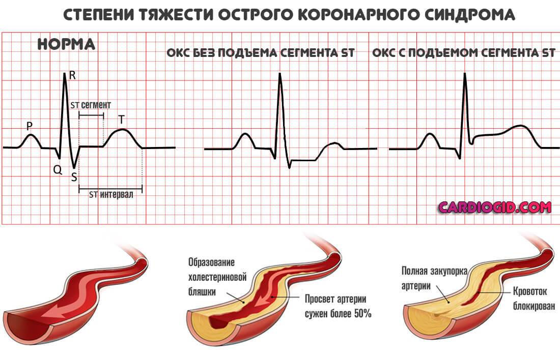 Острый инфаркт миокарда без подъема st