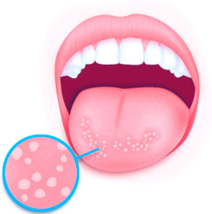 Мазь для лечения стоматита во рту для взрослых и детей, кремы и гели