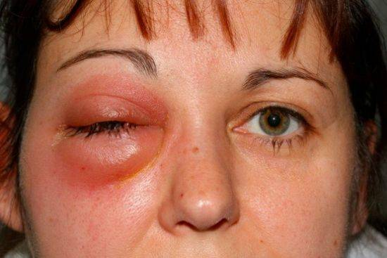 Как выглядит аллергия на лице: причины, симпомы, лечение, фото