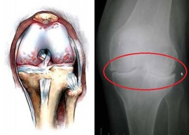 Лечение гонартроза коленного сустава 3 степени по бубновскому