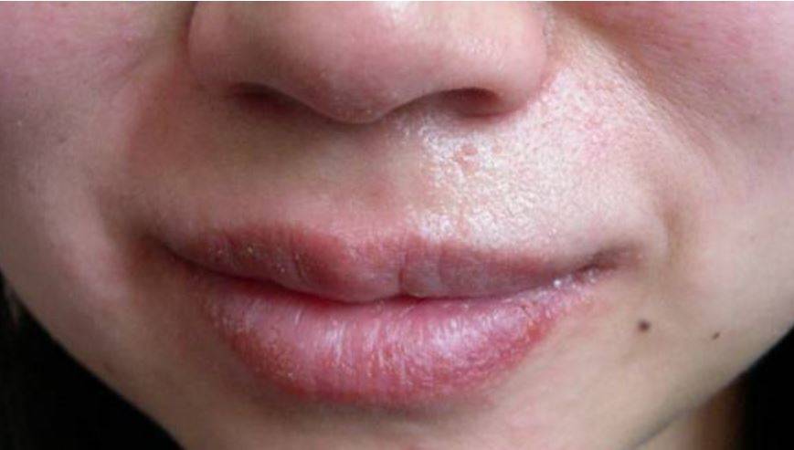 Нос шелушится и кожа вокруг крыльев: причины и лечение шелушения