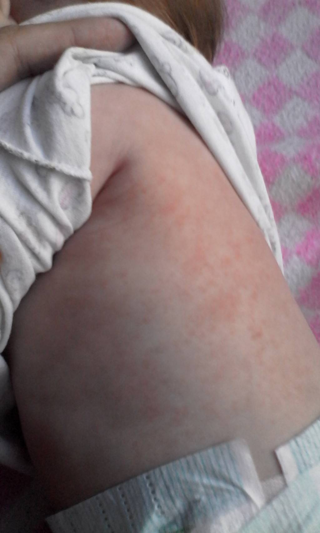 Аллергия без высыпаний на коже • аллергия и аллергические реакции