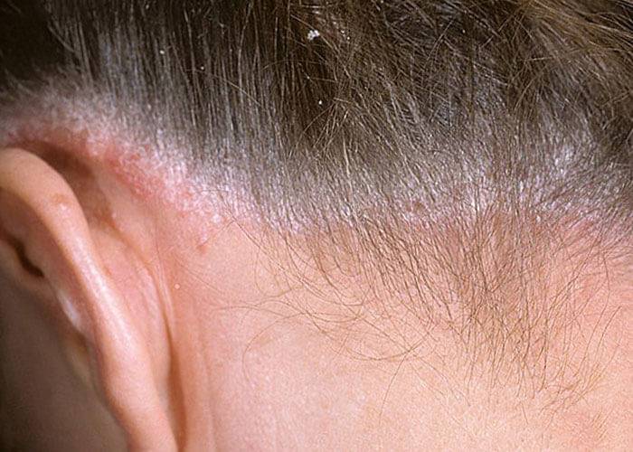 Шелушение кожи головы: от чего возникает и как избавиться