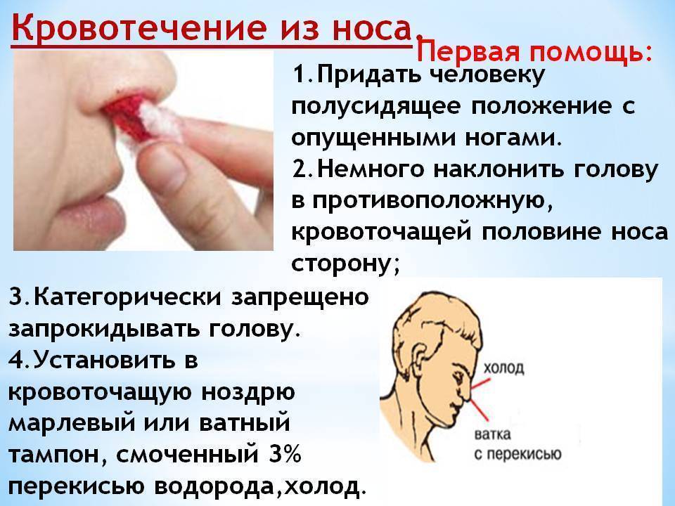 Кровотечение из носа: причины, сильное, частое, обильное, лечение носового кровотечения
