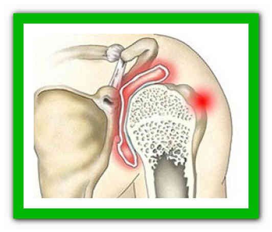 Синовит плечевого сустава симптомы лечение