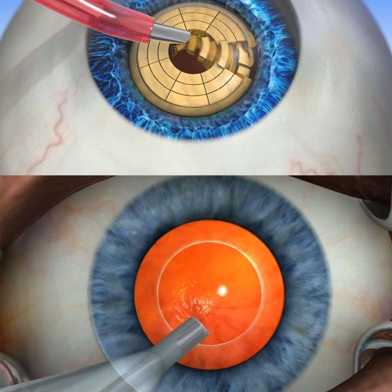Операция катаракты в краснодаре