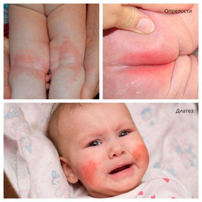 Пеленочный дерматит у новорожденных девочек, мальчиков. лечение, фото, клинические рекомендации