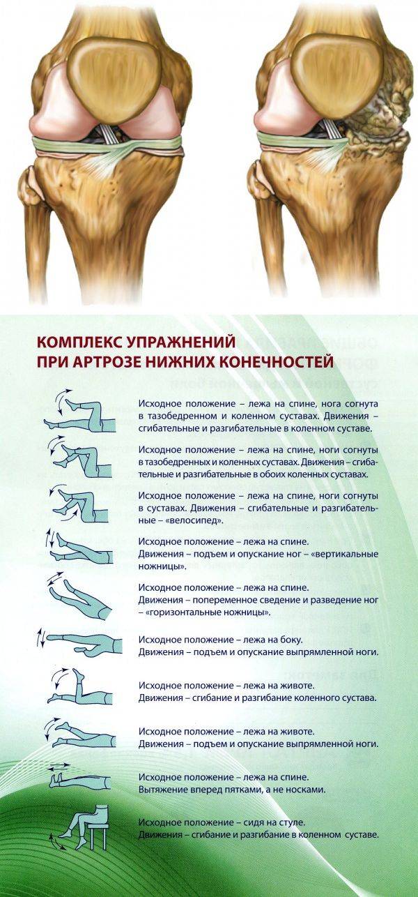 Упражнения при остеоартрозе плечевого сустава — суставы