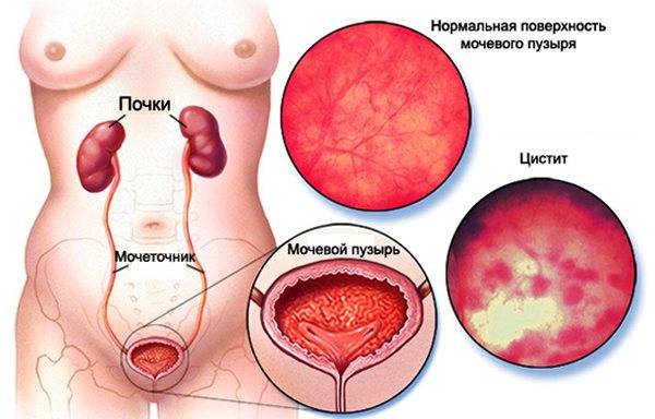 Лейкоплакия мочевого пузыря у женщин, мужчин. что это такое, симптомы, лечение лазером, антибиотиками — medists.ru
