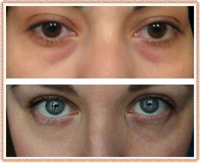 Темные круги под глазами у ребенка : причины и лечение | компетентно о здоровье на ilive