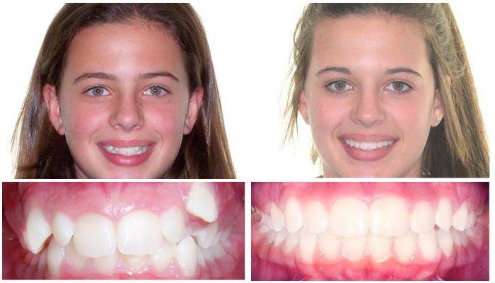 Как меняется лицо после брекетов, фото до и после
