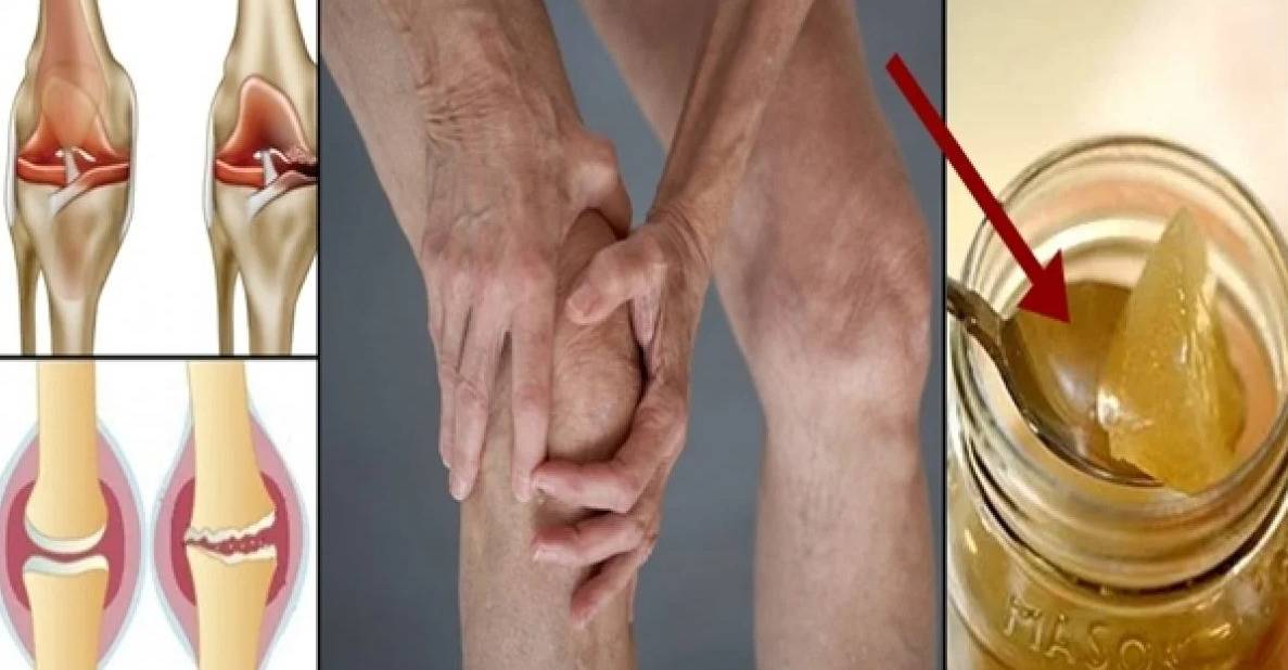 Боли в коленях: лечение в домашних условиях. народные средства для лечения коленных суставов