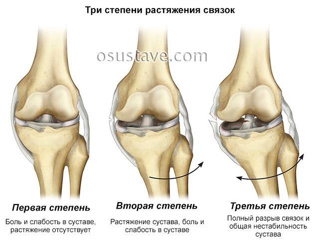 Сколько заживает растяжение связок тазобедренного сустава