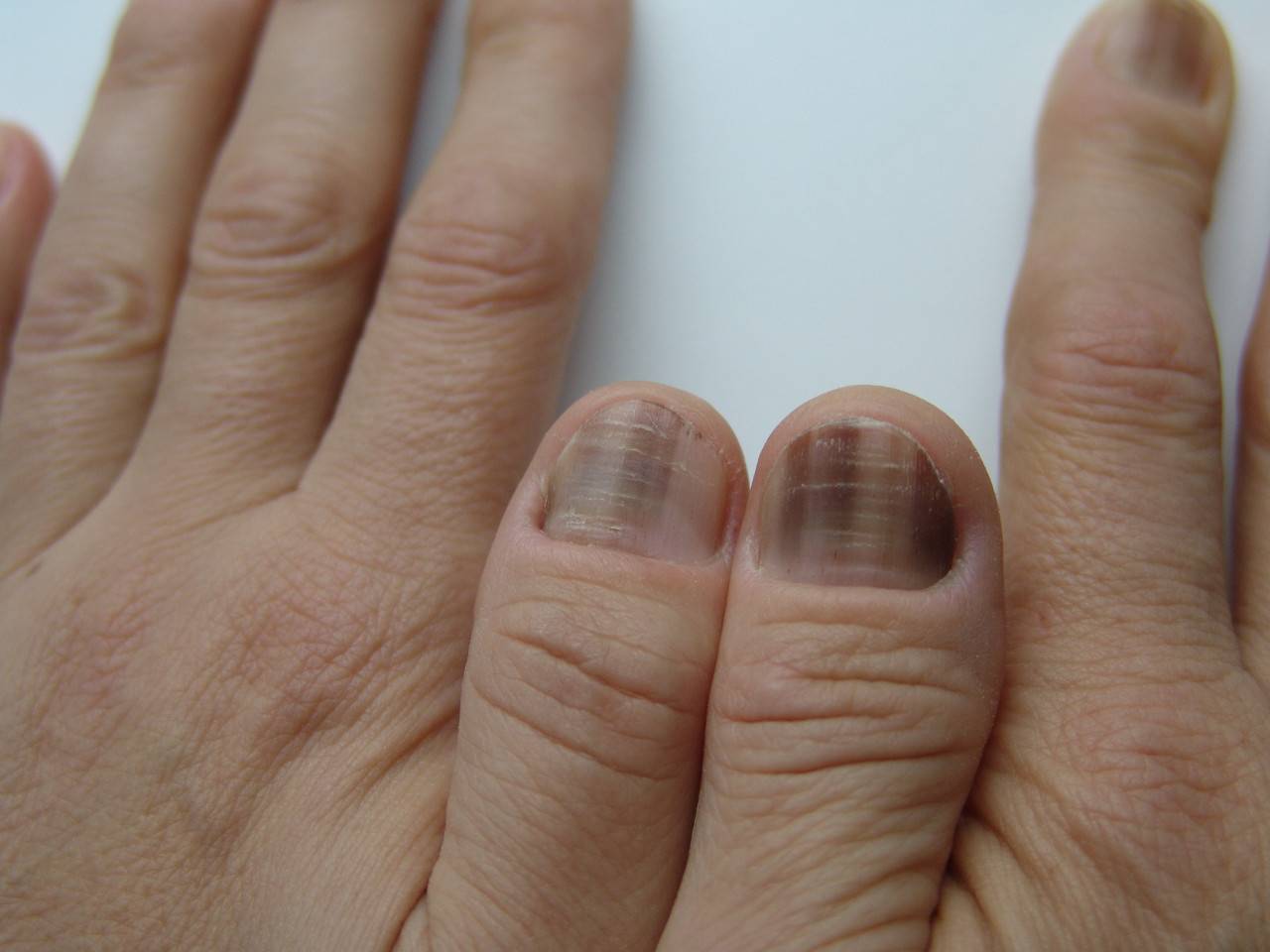 Диагностика по ногтям - признаки для определения заболевания по изменениям цвета, состояния и твердости