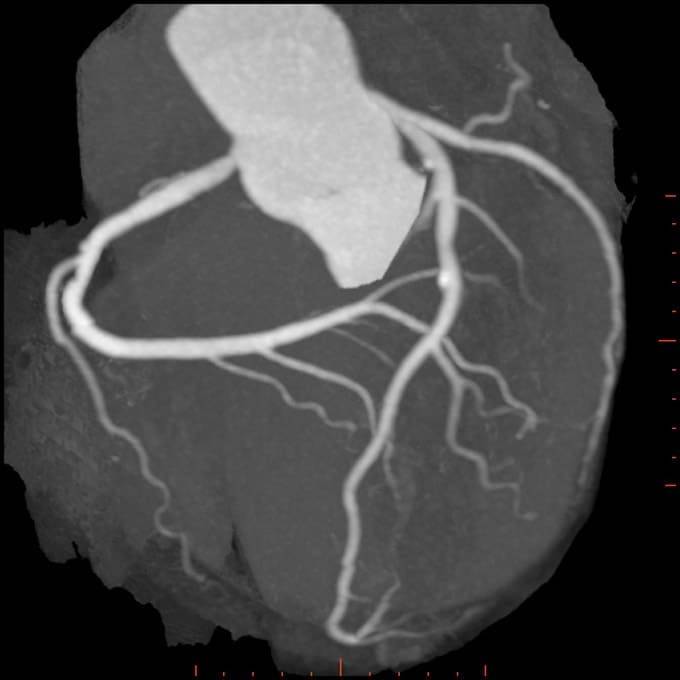 Кт-коронарография сосудов сердца: описание, исследования, показания и противопоказания, отзывы