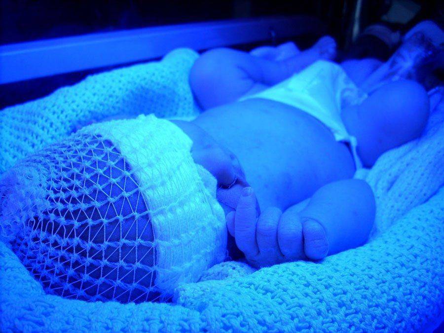 Как выбрать и правильно использовать лампу от желтушки для новорожденного