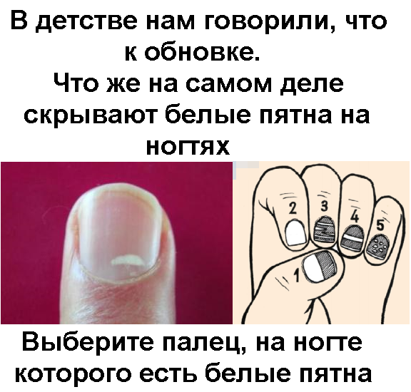 Исчерченность на ногтях что означают. почему появляются продольные бороздки на ногтях? точечные углубления на поверхности ногтей