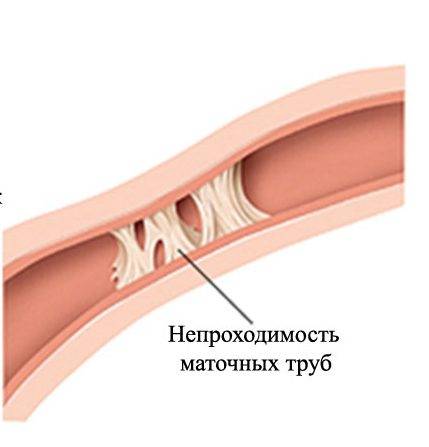 Непроходимость маточных труб. причины, симптомы и признаки, диагностика и лечение болезни :: polismed.com