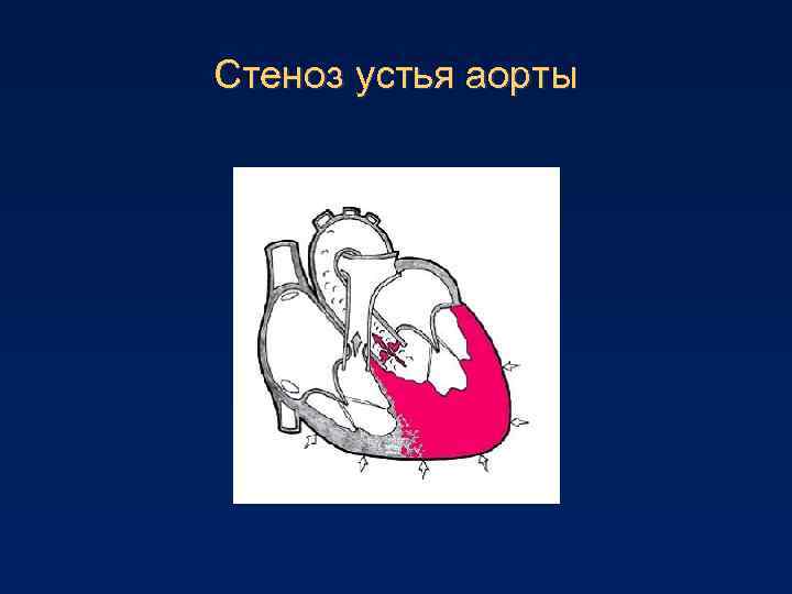 Аортальный-митральный порок сердца: уплотнение створок клапана и комбинированный недуг