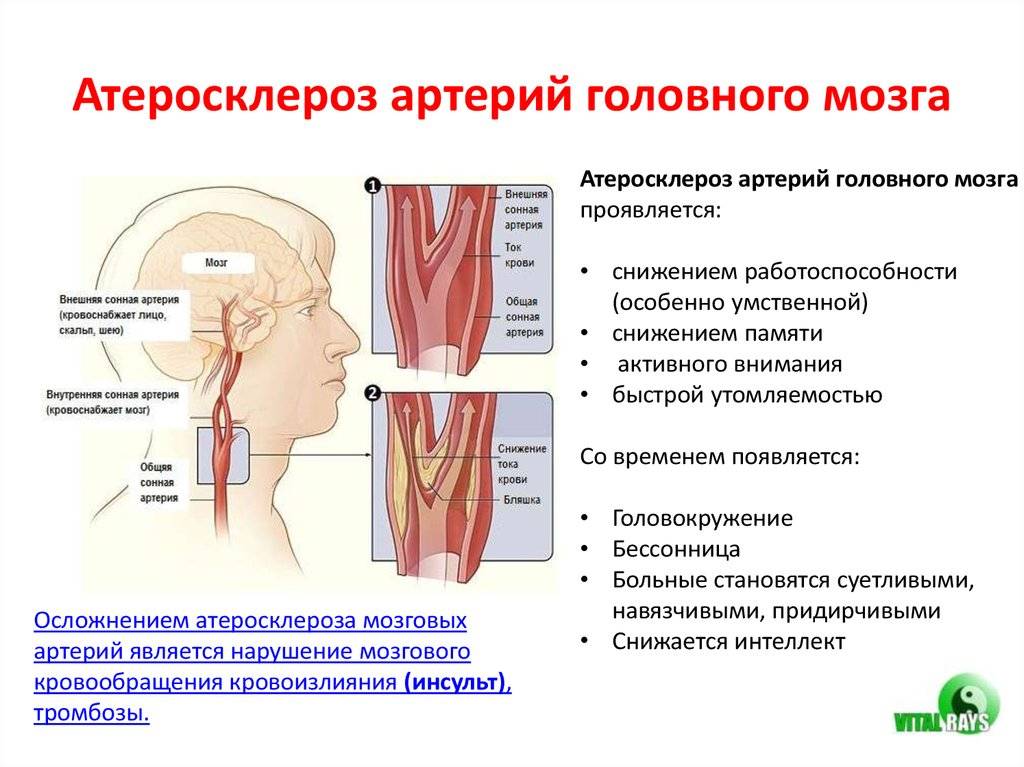 Атеросклероз сосудов головного мозга. симптомы, лечение, факторы риска заболевания - всё о склерозе