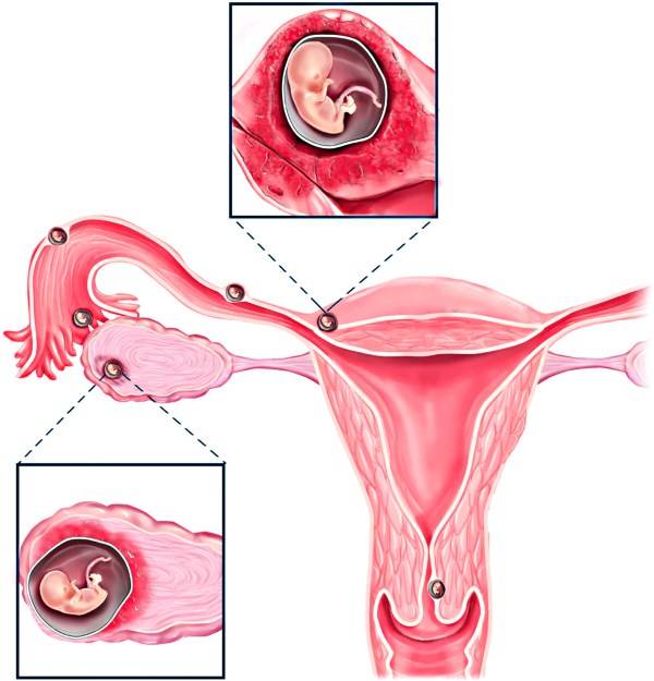 Загиб матки: индивидуальная особенность  или патология? - планирование беременности. эко