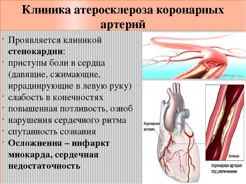 Распад сосудов. Клинические проявления атеросклероза коронарных артерий. Ишемическая болезнь сердца атеросклероз коронарных артерий. Симптомы поражения коронарных артерий. Стеноз коронарных артерий симптомы.