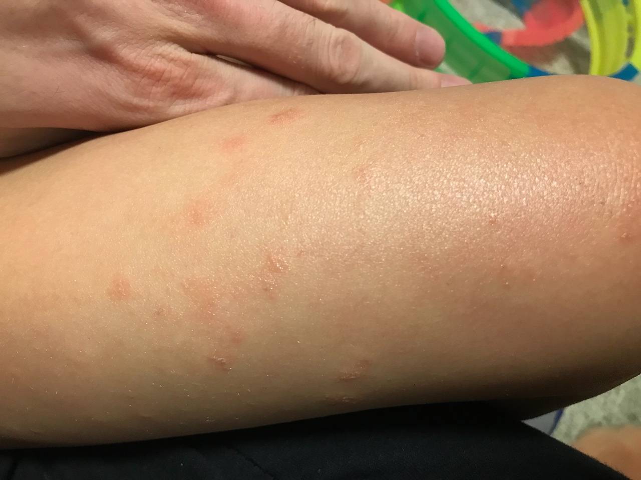 Аллергия сыпь на ногах чем лечить при беременности