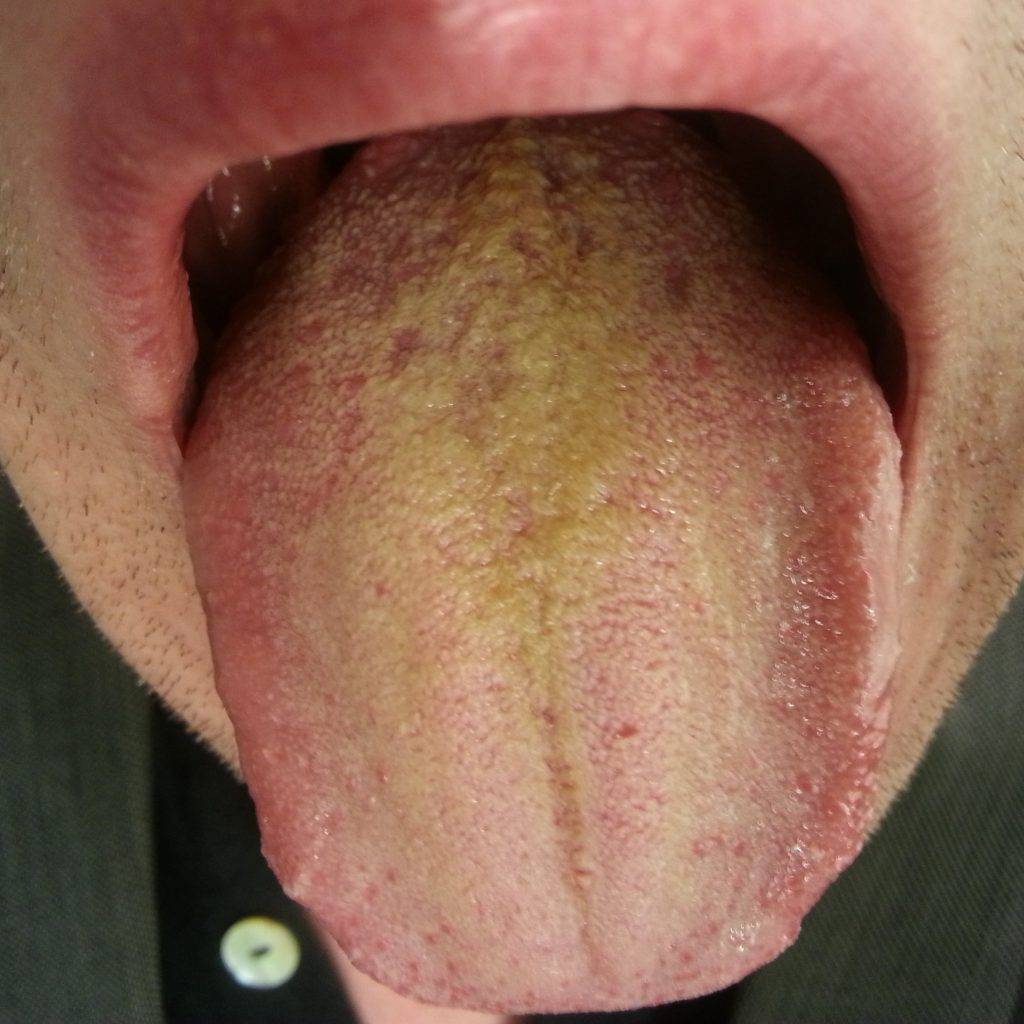 Обложен язык белым налетом: симптомы появления, причины и лечение заболеваний