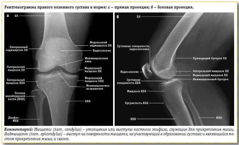 Мыщелок ноги. Рентген нормального коленного сустава. Коленный сустав рентген норма. Расшифровка рентгена коленного сустава. Рентгеновский снимок сустава колена норма.