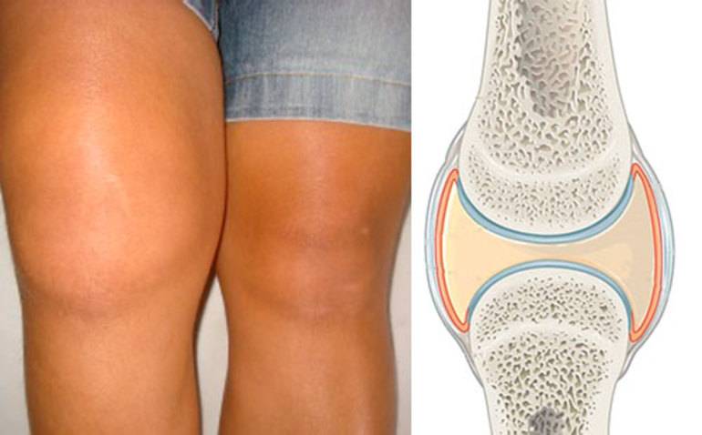 Уменьшение отечности. Синовит коленного сустава. Препателлярный бурсит. Что такое синовит коленного коленного сустава.
