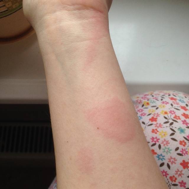 Появление красных пятен на коже: причины и лечение аллергии, почему пятна чешутся, фото